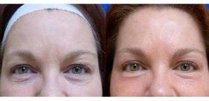 Botox By Dr. P. Alexander Ataii, M.D., Dermatologist In San Diego, California