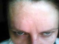 Botox Cosmetic Is The Most Popular Minimally Invasive Physician Administered Aesthetic Procedure