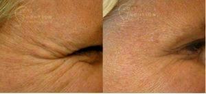Botox Dr. Scott K. Thompsonto Crow's Feet By ,Salt Lake City