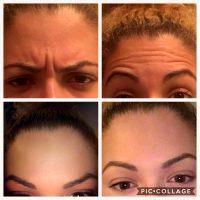 Botox Effects Can Typically Last Anywhere From Three To Six Months