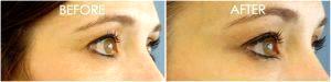 Botox For Crow's Feet By Dr.Karen Horton,San Francisco