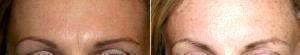 Botox For Fine Lines And Wrinkles On The Glabella (between Brows) With Dr. Lee P. Laris, DO, Phoenix Dermatologist