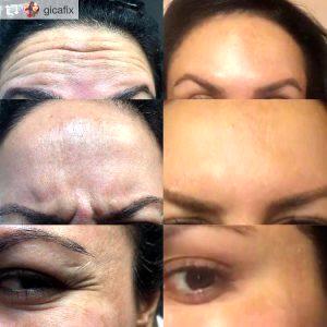Botox Forehead, Frow Lines, Crows Feet In Phoenix