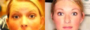 Botox Forehead Lines At Davis Dental Center, PSC, Dentist Louisville, KY