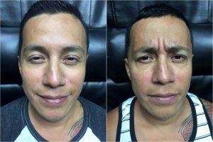 Botox Frown Lines At SDBotox, Plastic Surgery Clinic In San Diego, California