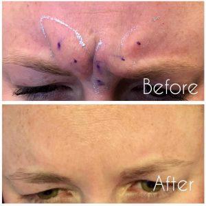 Botox Frown Lines By Dr. Avron Lipschitz, MD, Palm Beach Gardens, FL Plastic Surgeon