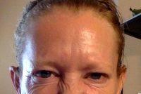 Botox Has Been Approved By The FDA As A Safe And Effective Therapy Drug