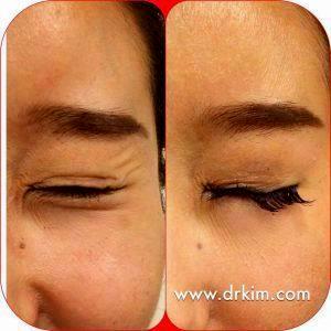 Botox In Crow's Feet By Dr.Kim,San Francisco