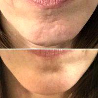 Botox Injectables For Chin Lines By Dr. David Rankin, West Palm Beach Plastic Surgeon