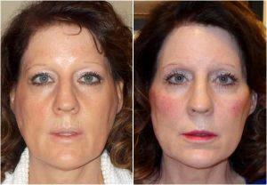 Botox Injection By Dr. Emilio Justo