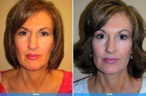 Botox Injection By Dr. Geoffrey E. Leber, M.D. FACS