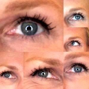 Botox Injection By Dr. Karen M. Horton, San Francisco