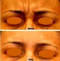 Botox Injection Procedure With Doctor Evan Ransom, San Francisco Plastic Surgeon