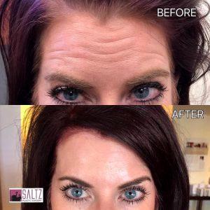 Botox Injections By DR. RENATO SALTZ,Salt Lake City