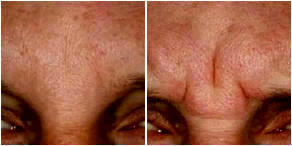 Botox Injections Glabella In Salt Lake City Utah