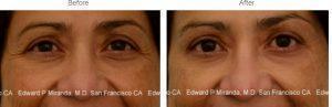 Botox Injections To Crow's Feet & Glabella By Dr. Edward P. Miranda, San Francisco.