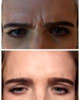 Botox Is A Naturally-occurring Protein Made By The Bacteria Clostridium Botulinum