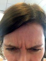 Botox Is Also Effective In Preventing The Development Of These Lines