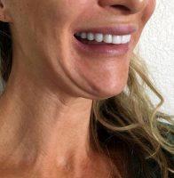 Botox Is Certainly A More Common Treatment Not Only For Women But For Men As Well