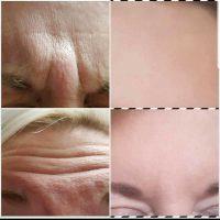 Botox Is The Most Common Cosmetic Procedure