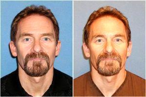 Botox Of Forehead By Dr. Emilio Justo, Arizona