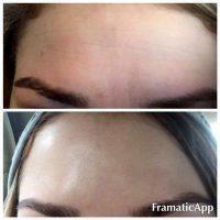 Botox OnabotulinumtoxinA Result With Doctor Corey S. Maas, San Francisco Plastic Surgeon