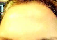 Botox OnabotulinumtoxinA Results Pic By Dr. M. Bradley Calobrace, Louisville Plastic Surgeon