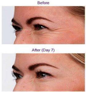 Botox Procedure At Presidio Dermatology,San Francisco