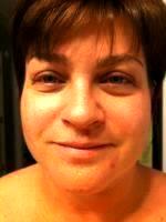 Botox Reduces Muscle Activity That Causes Moderate To Severe Lines To Form