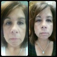 Botox Results Can Be Seen A 3-5 Days After Your Procedure