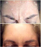 Botox San Diego Mission Valley