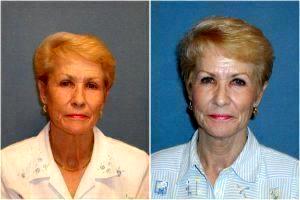 Botox To Her Forehead And The Sides Of Her Eyes (crows Feet) By Dr. Emilio Justo,Arizona