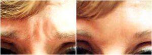 Botox To The Glabella To Eliminate The Frown Lines Between Her Eyebrows By Anita Mandal, M.D., Doctor In Palm Beach Gardens, Florida