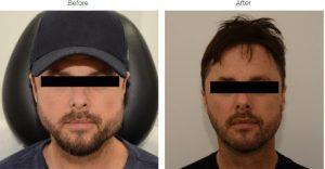 Botox To The Masseter Muscle By Dr. Edward P. Miranda,San Francisco