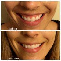 Botox Toxin Smile Lines With Dr Robyn D. Siperstein, West Palm Beach Plastic Surgeon