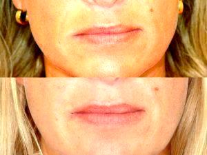 Botox Treatment Gateway Aesthetic Institute And Laser Center,Salt Lake City