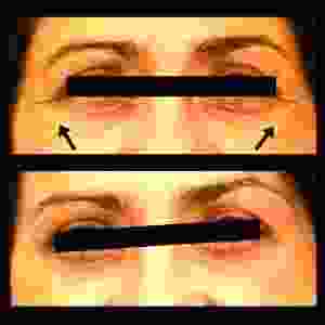 Botox Treatment To The Crowsfeet And Rejuvenate One Of Your Eyes By Dr. Dudas,San Francisco