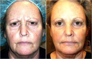 Botox TreatmentDr. Emilio Justo,Arizona