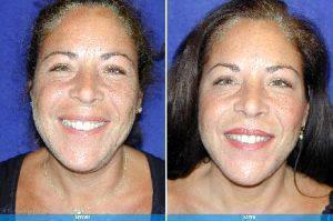 Botox Treatments By Dr.Geoffrey E. Leber, M.D. FACS