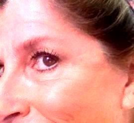 Botox Typically Lasts 3-6 Months, However, You Can Safely Repeat Botox Cosmetic Treatment Every Three Months