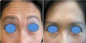 Botox With Dr Bryan K. Chen, MD, San Diego Dermatologist