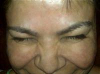 Botox Works By Partially Blocking The Impulses From The Nerve To The Facial Muscles