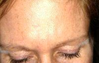 Botulinum Toxin A Is Marketed Under The Brand Names Botox