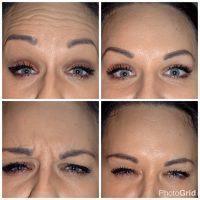 Botulinum Toxin Injections Photos With Dr James R. Wharton, Louisville Plastic Surgeon