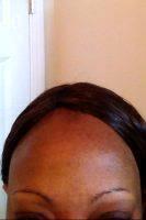 Bruising Is The Most Common Side Effect