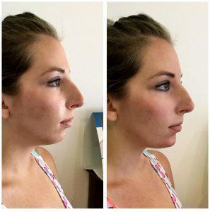 Chin Augmentation Voluma By Los Angeles Cosmetic Surgeon Dr. Robert Cohen