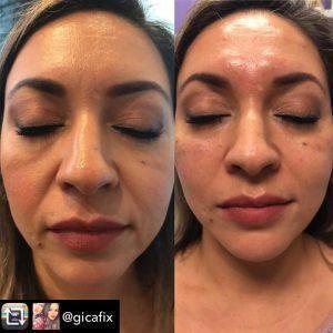 Correction Of Nasal Folds At National Laser Institute Med Spa, Scottsdale, AZ