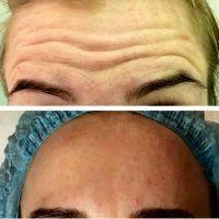 Cosmetic Botox Injections By Dr Donn R. Chatham, Louisville Plastic Surgeon