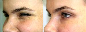 Crows Feet Botox By Dr. Mark R. Murphy, MD, Plastic Surgeon In Palm Beach Gardens, Florida