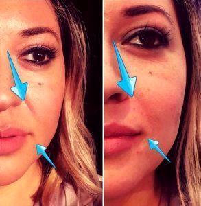 Dermal Fillers At National Laser Institute Med Spa, Scottsdale, AZ